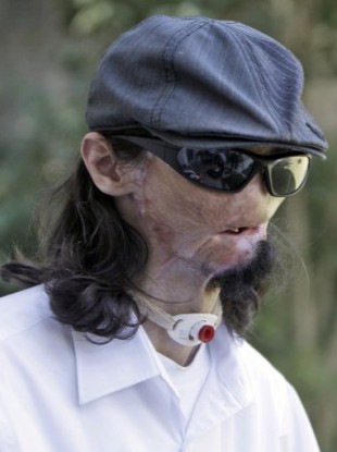 October 2010 file photo of Dallas Wiens, who underwent a full face transplant in Boston recently.