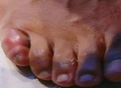 Haye shows his broken baby toe to the Sky Sports cameras after losing to Wladimir Klitschko on a unanimous decision.