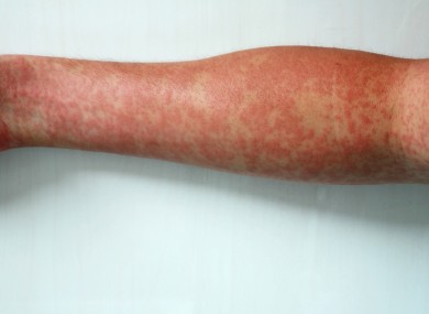 Measles is a highly contagious virus.