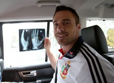 Tommy Bowe holds up his hand X-ray.