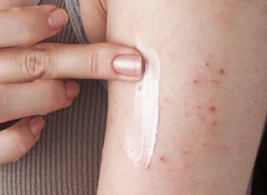 eczema