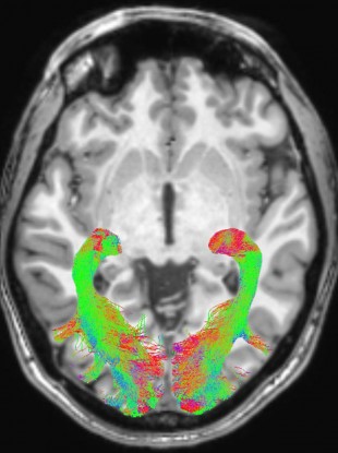MRI of the brain