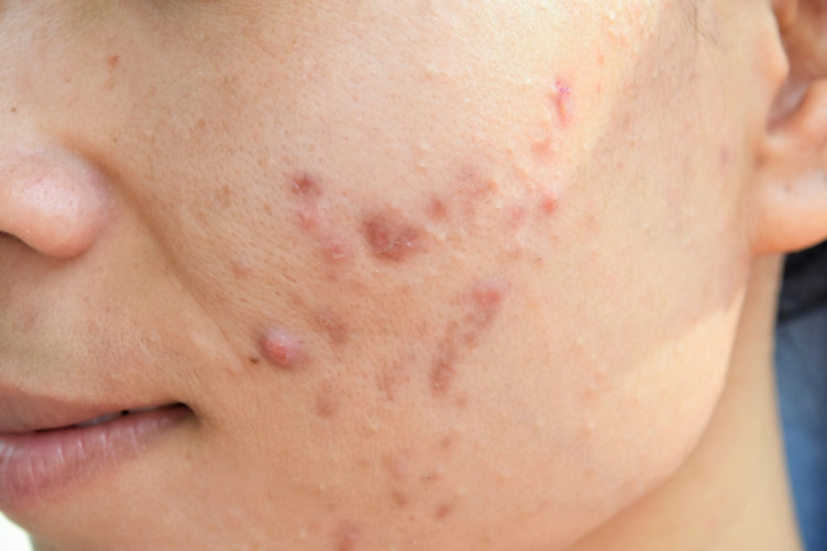 q for skin acne
