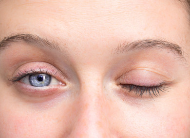 AFP can cause paralysis including difficulty moving eyes and drooping eyelids.