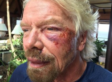 Sir Richard Branson after he was involved in an accident when he crashed his bicycle.