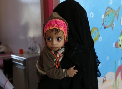 A mother carries her malnourished child as the child receives medical treatment in Al-Sabeen hospital in Sanaa, Yemen, in February.